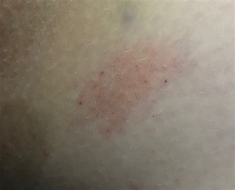 Высыпание внутри бедра с зудом - Вопрос дерматологу - 03 Онлайн