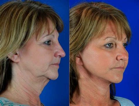 Neck Lift Surgery In Islamabad Rawalpindi And Pakistan Neck Lipo