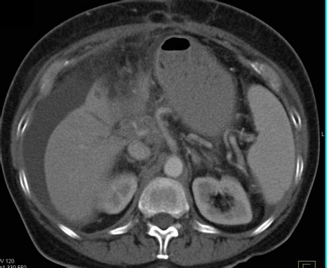 Cirrhosis With Ascites Liver Radiology Case Studies Ctisus Ct Scanning