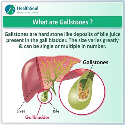 Gallstones Symptoms Diagnosis And Treatment Healthsoul