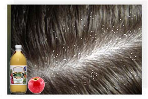 Dandruff Trouble: Dandruff Trouble & Caring Tips For Dandruff Remedys