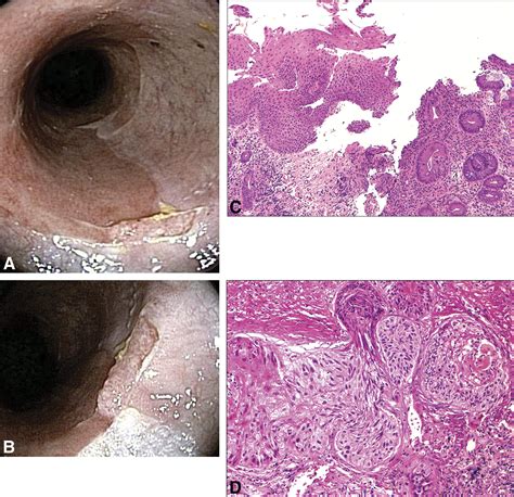 Squamous Cell Carcinoma Complicating Chronic Ulcerative Colitis