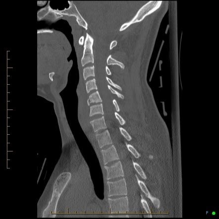 Flexion Teardrop Fracture Radiology Case Radiopaedia Org