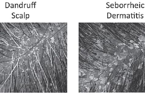 Berita Perbedaan Ketombe Dan Dermatitis Seboroik Terbaru Hari Ini