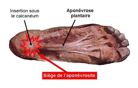 Pathologies Apon Vrosite