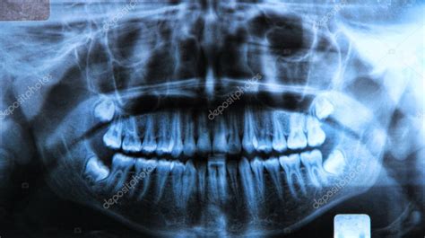 Radiografia Dentale Panoramica Foto Stock Foto Immagini Bunyos