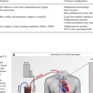 ECMO Procedure Adult