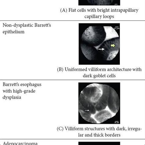 Characteristics Of Dysplastic Barretts Esophagus In Probe Based