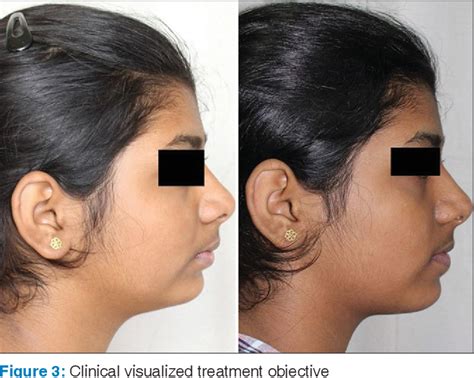 Figure 3 From Correction Of Class Ii Malocclusion In A Patient Using The Forsus Fatigue