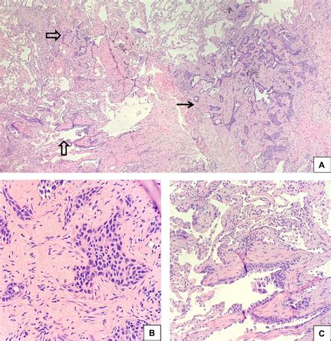 A Invasive Squamous Cell Carcinoma Scc Arising In A Scar Arrow Download Scientific