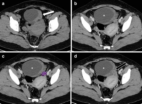 A 38 Year Old Woman With Surgically Confirmed Left Ovarian Mucinous