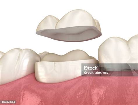 Foto De Onlay Fixação Da Coroa Cerâmica Sobre O Dente Molar Ilustração