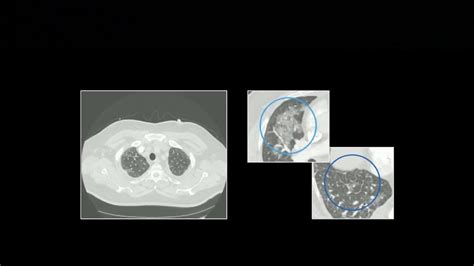 Acute Pulmonary Presentations Part 1 Free Radiology Cme Youtube