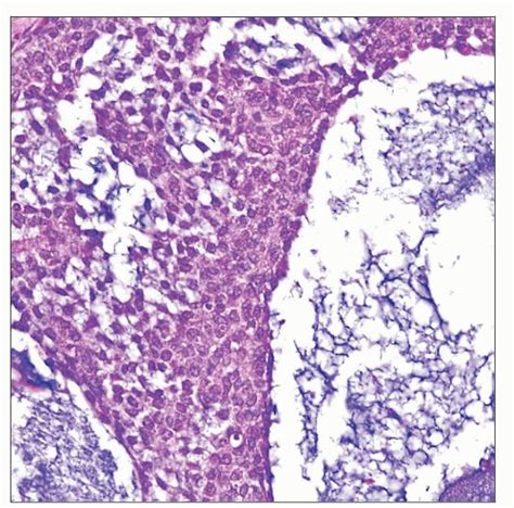 Juvenile Granulosa Cell Tumor | Basicmedical Key