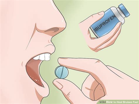 How To Heal Bruises Fast Steps With Pictures Wikihow