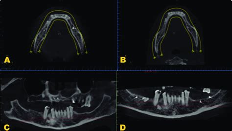 A B Cbct Axial Cross Section C D Reformatted Panoramic View