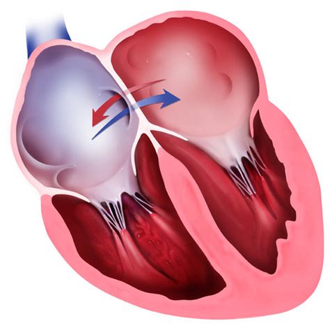 Heart with Atrial Septal Defect - medmediasolutions