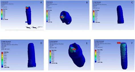 Von Mises Stress In The Implant Body At Varying Dimensions And Loads Download Scientific