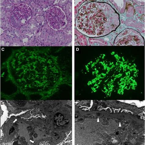 Renal Biopsy Findings A B Light Microscopy Pas And Masson S Stain Download Scientific