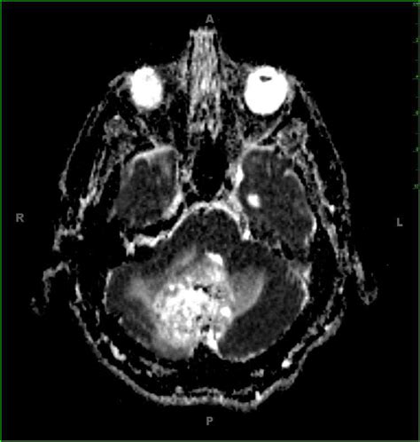 Hemangioblastoma Neuro Mr Case Studies Ctisus Ct Scanning