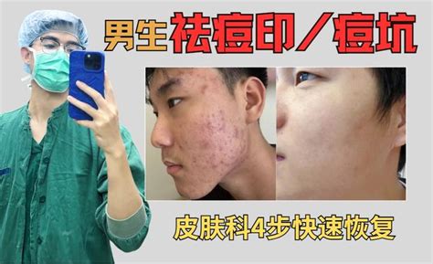 男生满脸痘印、痘坑，怎样才能短时间去除？皮肤科医生教你科室专用祛痘坑、痘印方法，专攻男士痘印痘坑脸，一个月恢复光滑肌肤，4步把痘印痘坑全去干净！ 知乎