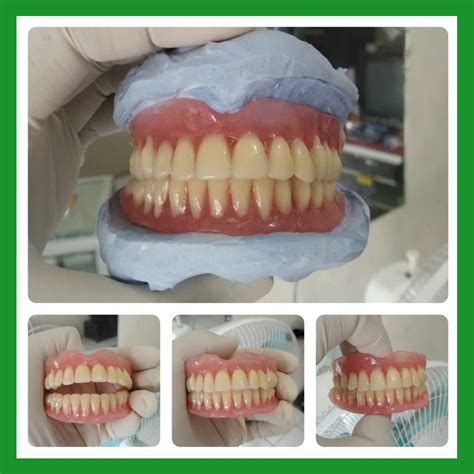 Gigi Palsu Akrilik Full Denture Ahli Gigi Palsu