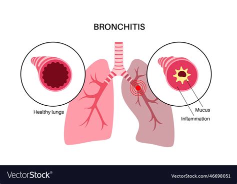 Bronchitis Lung Disease Royalty Free Vector Image