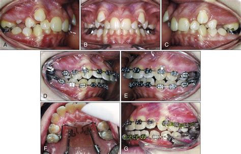 Class II Combination Therapy Molar Distalization And Fixed Functional