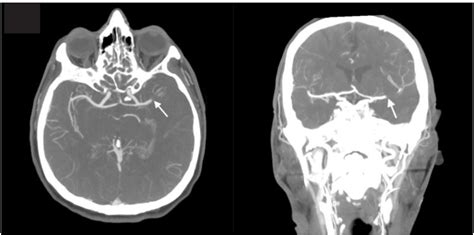 Usefulness of Computed Tomography Perfusion in Treatment of an Acute ...