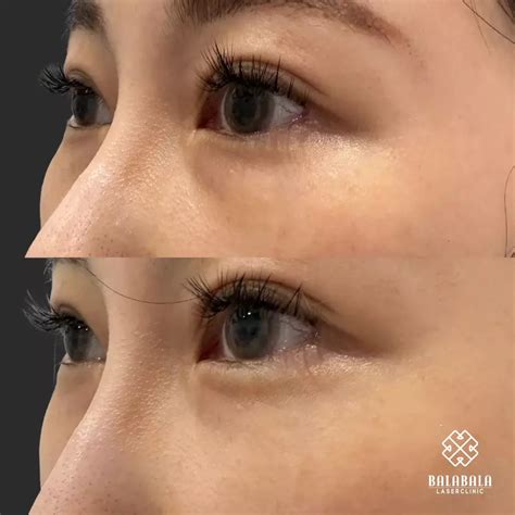 Tear Trough Filler Dark Circle Treatment Balabala Laser Clinic