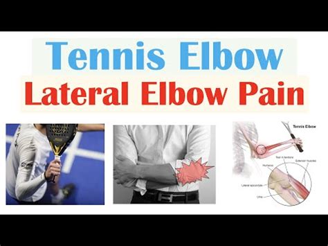 Tennis Elbow Lateral Epicondylitis Causes Pathophysiology