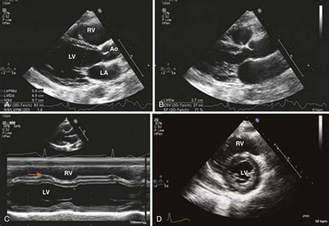 Distinguishing Systolic Versus Diastolic Heart Failurea Practical