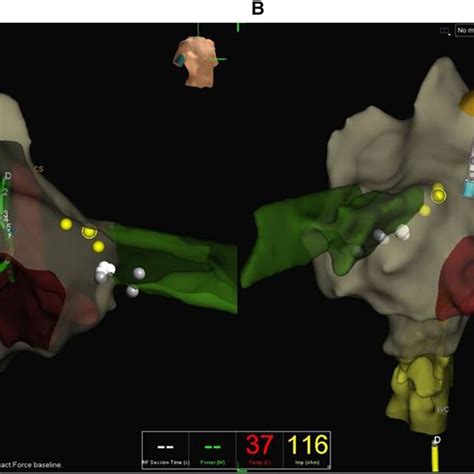 Electroanatomical Map Created With The Ensite Navx System In A Patient