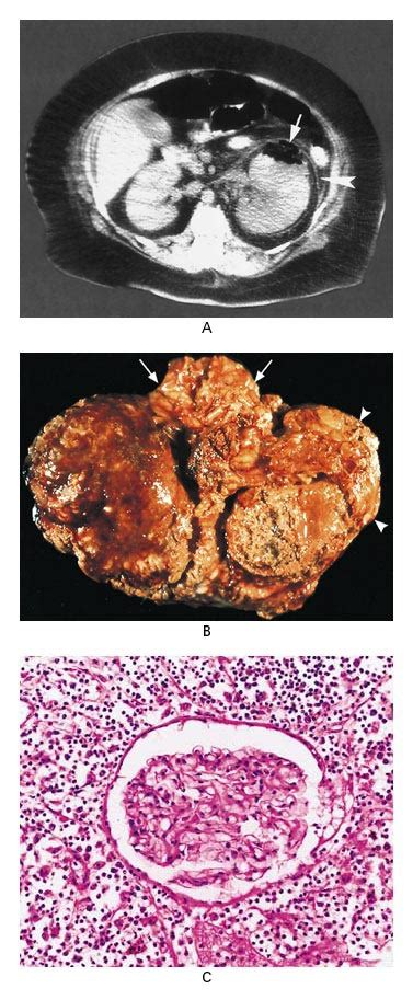 Emphysematous Pyelonephritis New England Journal Of Medicine