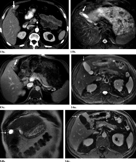 Adenomyomatosis In A Year Old Man A Contrast Enhanced