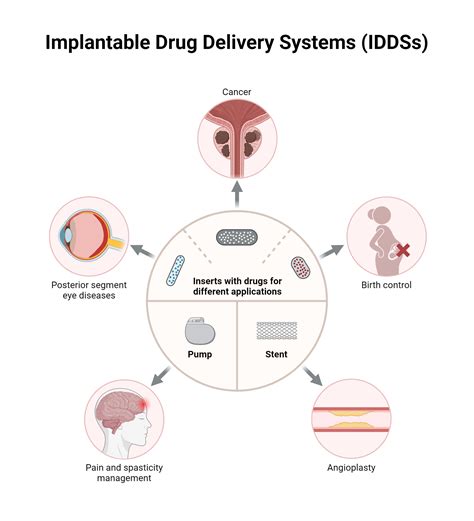 Implantable Drug Delivery Systems (IDDSs) | BioRender Science Templates