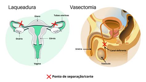 Novas Regras Para Laqueadura E Vasectomia Passam A Valer Nesta Segunda