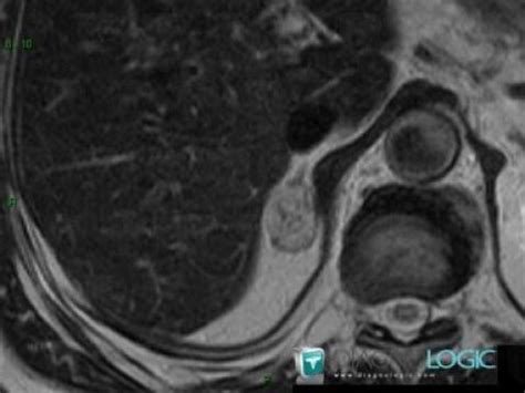 Radiology Case Hematoma Ct Mri Diagnologic