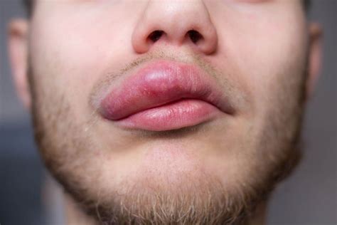 Angioedema O Que E Causas Sintomas E Tratamento NBKomputer