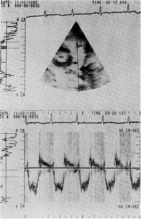 Figure From A Two Dimensional Doppler Echocardiographic Method For