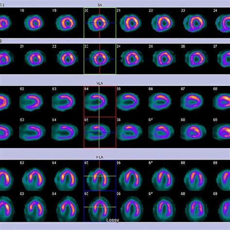 Lexiscan Stress Myocardial Perfusion Imaging Mpi Is Clinically And