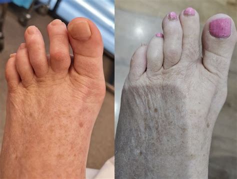 Hammertoe Correction 2 Foot Podiatry Surgery