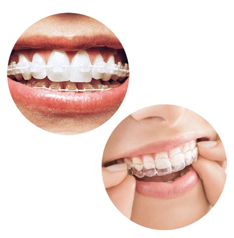 Invisalign Vs Six Month Smiles For Straight Teeth Chrysanthe Dental Care