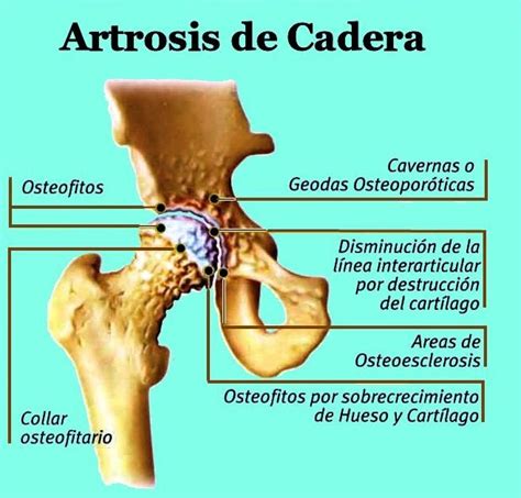 El Blog De Francisco Gilo Artrosis De Cadera