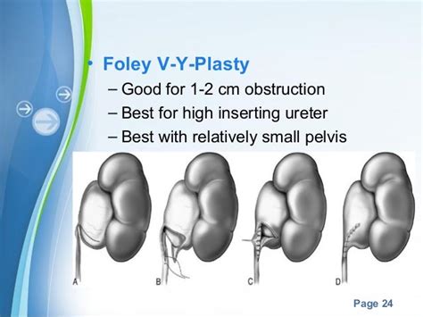 Congenital Ureteropelvic Upj Obstruction