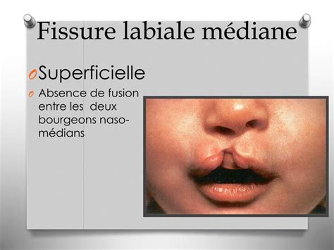 PPT Anomalies et malformations congénitales PowerPoint Presentation