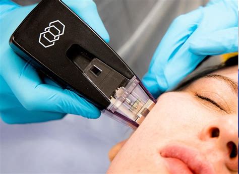 Unlocking The Secrets Of Morpheus8 For Acne Scarring Pulse Light