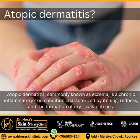 Atopic Dermatitis Treatments Dermatologist In Roorkee