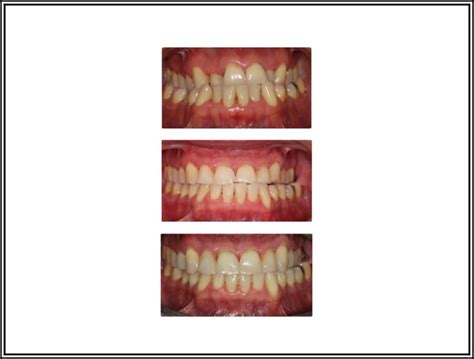 Class Iii Surgical 3 Schuchert Orthodontics