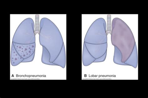 Respiratory Disorders Flashcards Quizlet